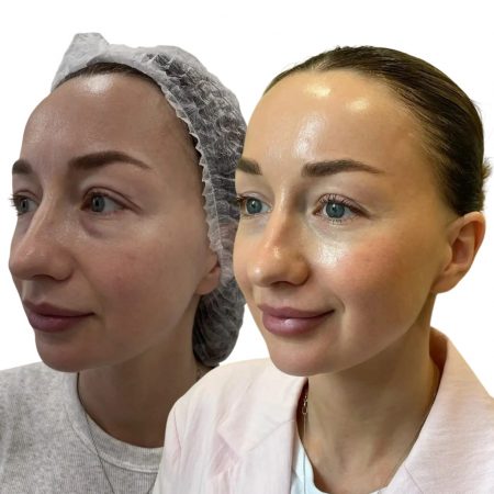 коллагенткерапия